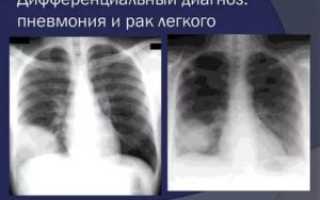 Пневмония и рак легких как отличить