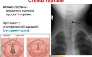 Стеноз трахеи у взрослых лечение