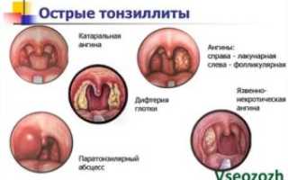 Ангина лакунарная и фолликулярная отличия