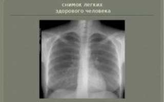 Рентгеновский снимок здоровых легких фото