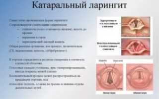 Узлы на голосовых связках симптомы