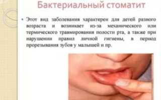 Бактериальный стоматит у детей лечение