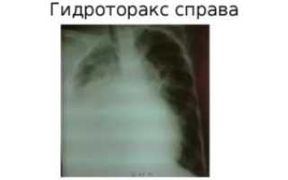 Малый гидроторакс справа