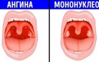 Как отличить мононуклеоз от ангины