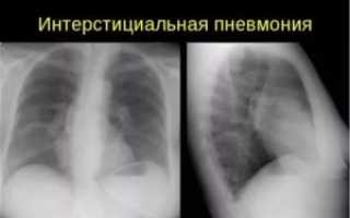 Интерстициальный пневмонит симптомы