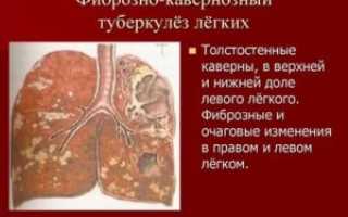 Фиброзно кавернозный туберкулез легких заразен или нет