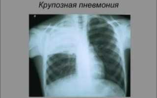 Плевропневмония симптомы и лечение