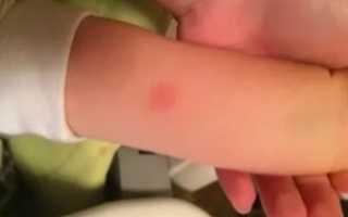 Последствия манту у ребенка