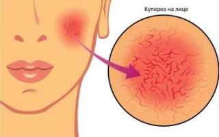 Как убрать сосуды на лице