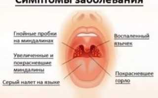 Постоянная ангина у ребенка что делать