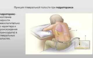 Пункция плевральной полости при гидротораксе
