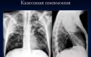 Казеозная пневмония фото