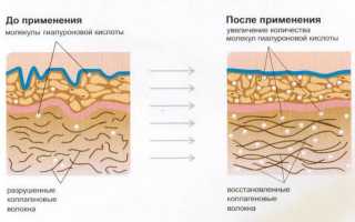 Биоревитализация рук