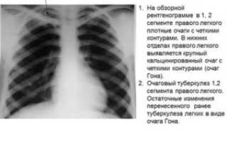Единичные очаги в легких что это