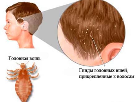 Как определить и вылечить педикулез
