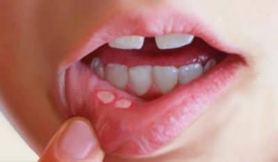 Кто такие паразиты и какие они бывают?