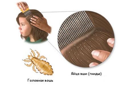 Обработка головы и белья при педикулезе