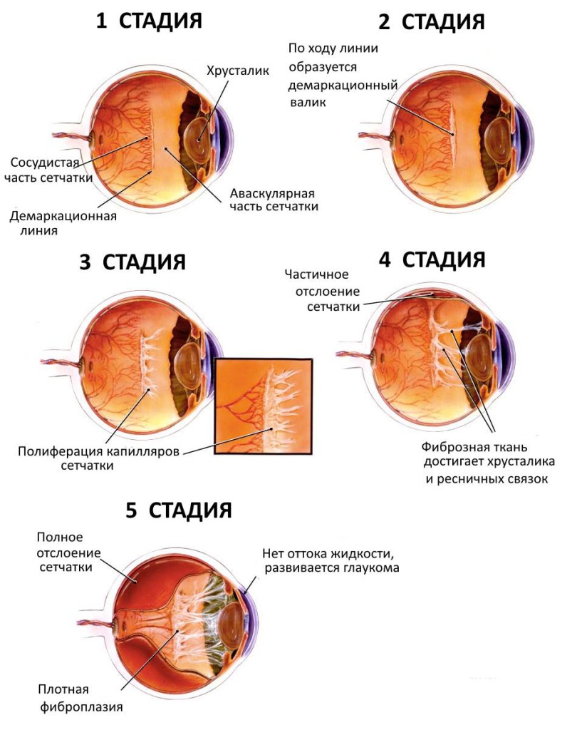 ретинопатия