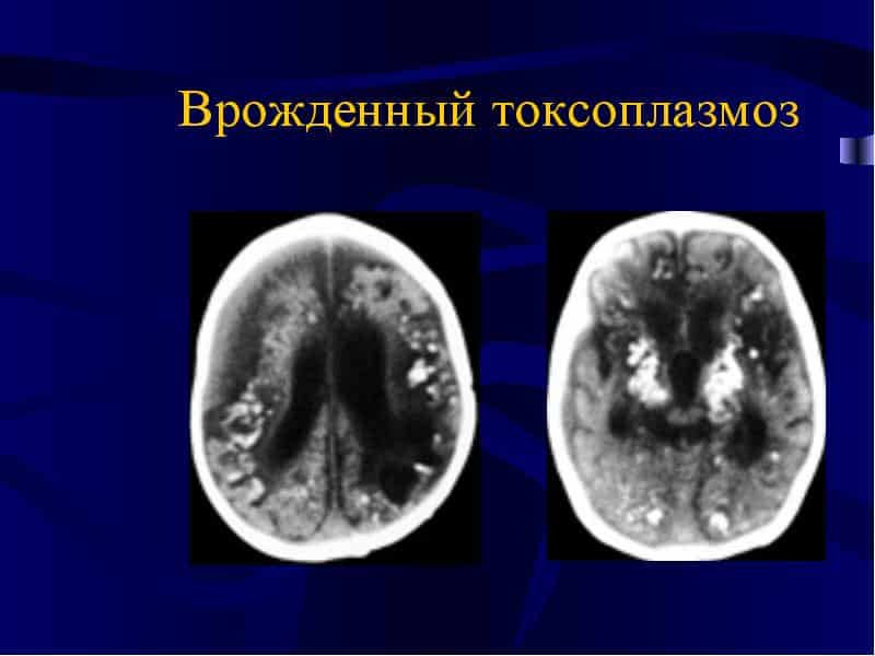Врожденное заболевание
