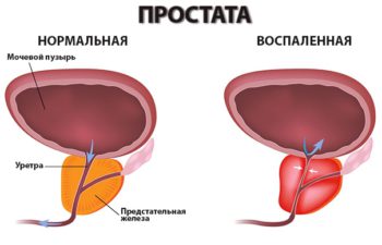 Чем опасен трихомониаз для женщин и для мужчин?